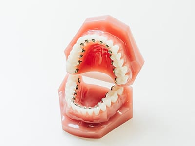 歯の裏側に矯正装置を付けることも可能です